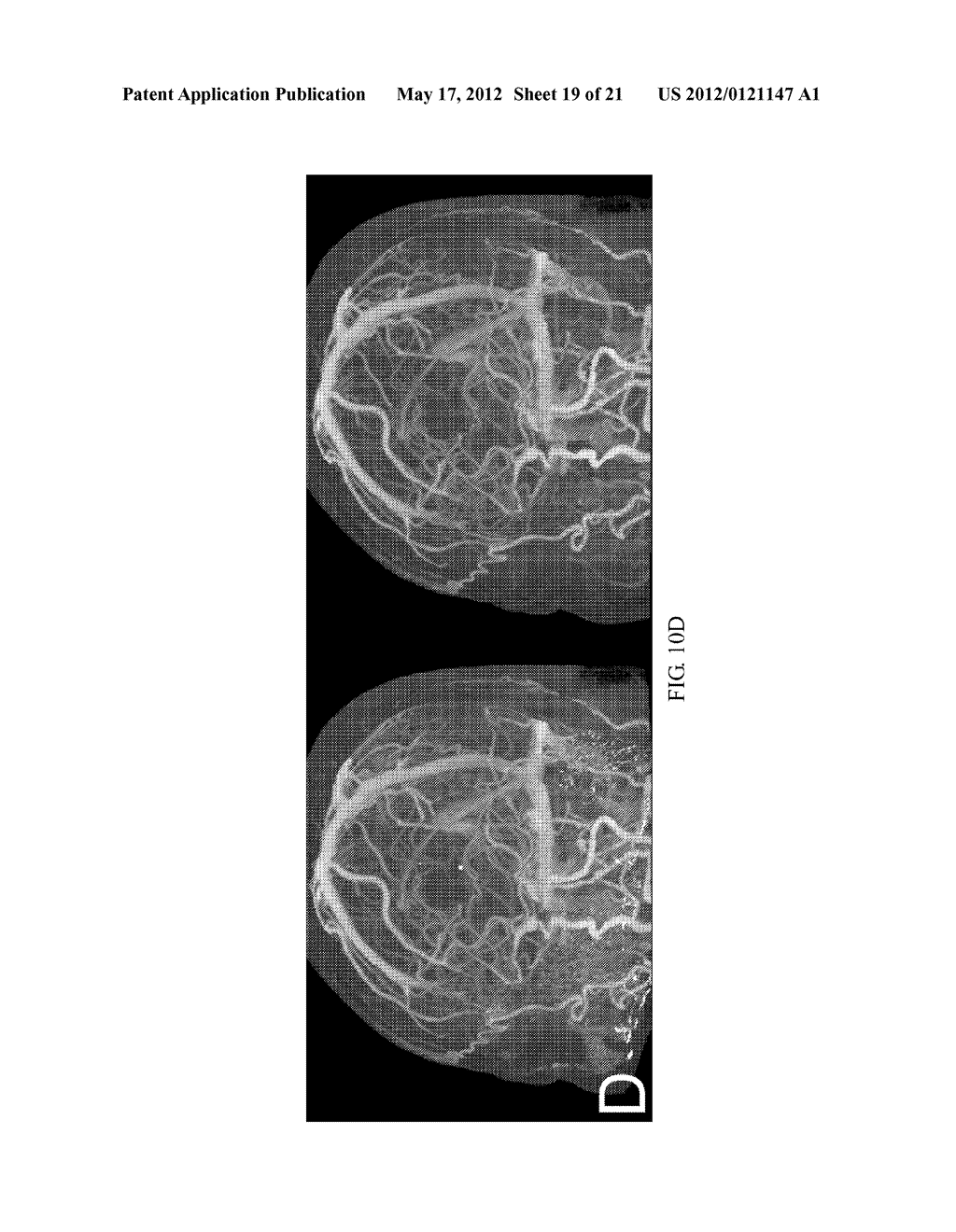 Method for Generating Bone Mask - diagram, schematic, and image 20