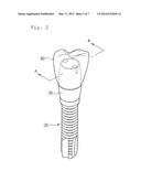 DENTAL IMPLANT diagram and image