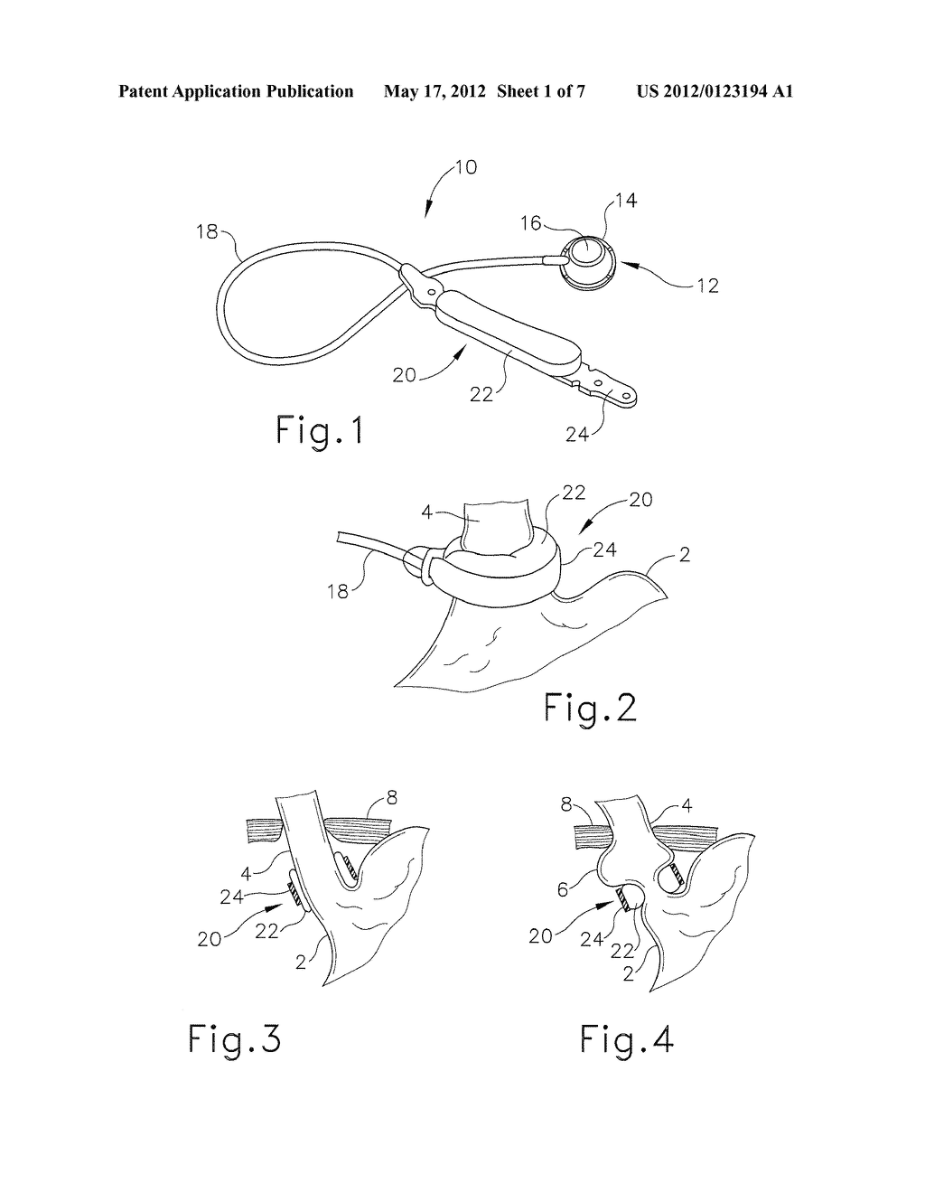 PRESSURE LIMITING DEVICE FOR GASTRIC BAND ADJUSTMENT - diagram, schematic, and image 02