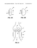 GASTRIC BAND WITH ASYMMETRICAL MEMBER diagram and image