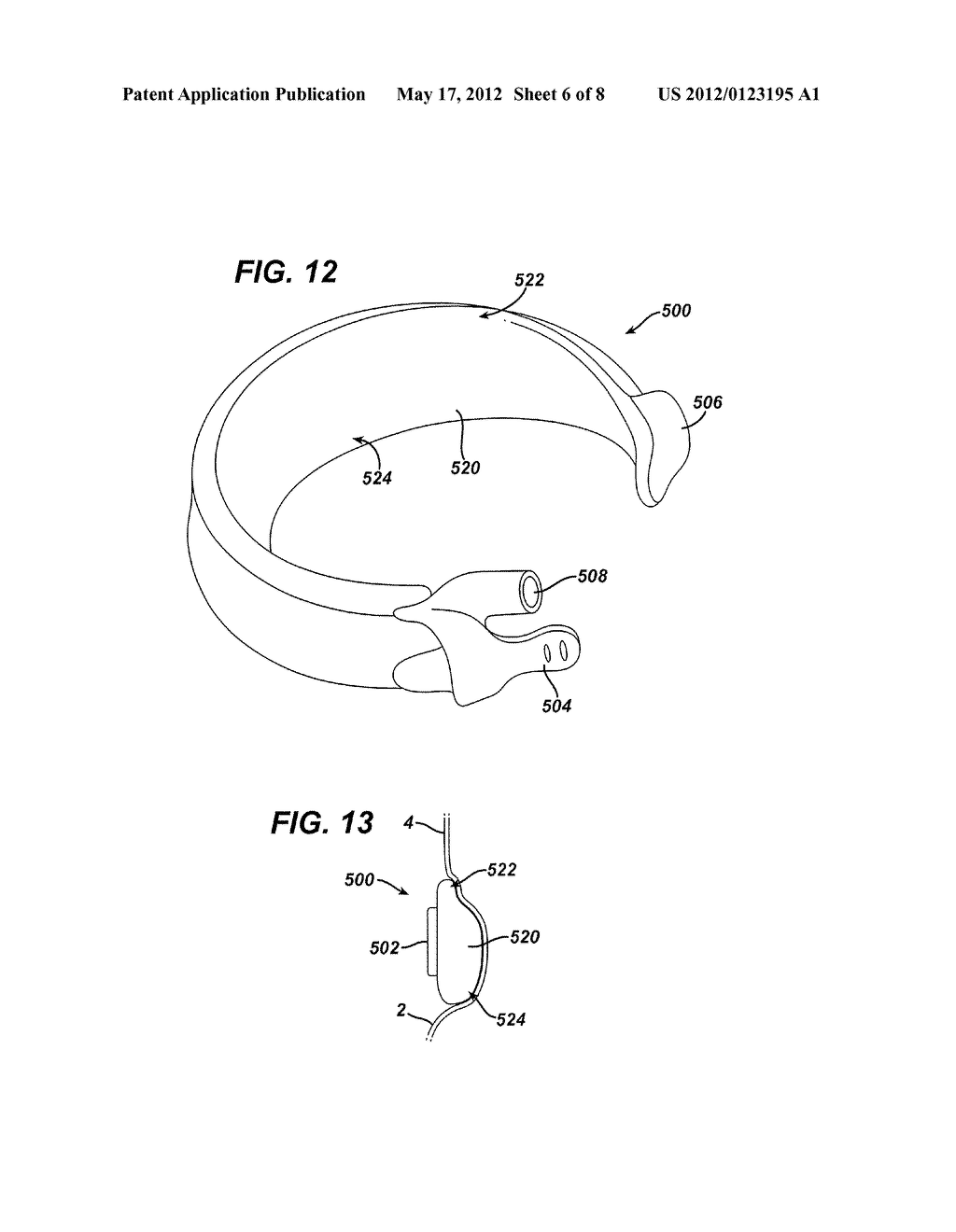 GASTRIC BAND WITH ASYMMETRICAL MEMBER - diagram, schematic, and image 07