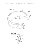 GASTRIC BAND WITH ASYMMETRICAL MEMBER diagram and image