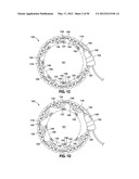 GASTRIC BAND DEVICES AND DRIVE SYSTEMS diagram and image