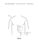 GASTRIC BAND DEVICES AND DRIVE SYSTEMS diagram and image