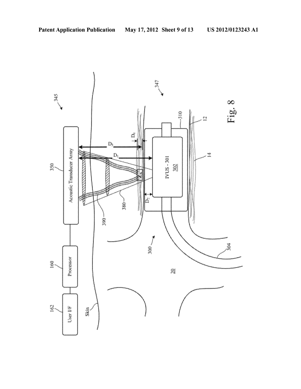 CATHETER GUIDANCE OF EXTERNAL ENERGY FOR RENAL DENERVATION - diagram, schematic, and image 10