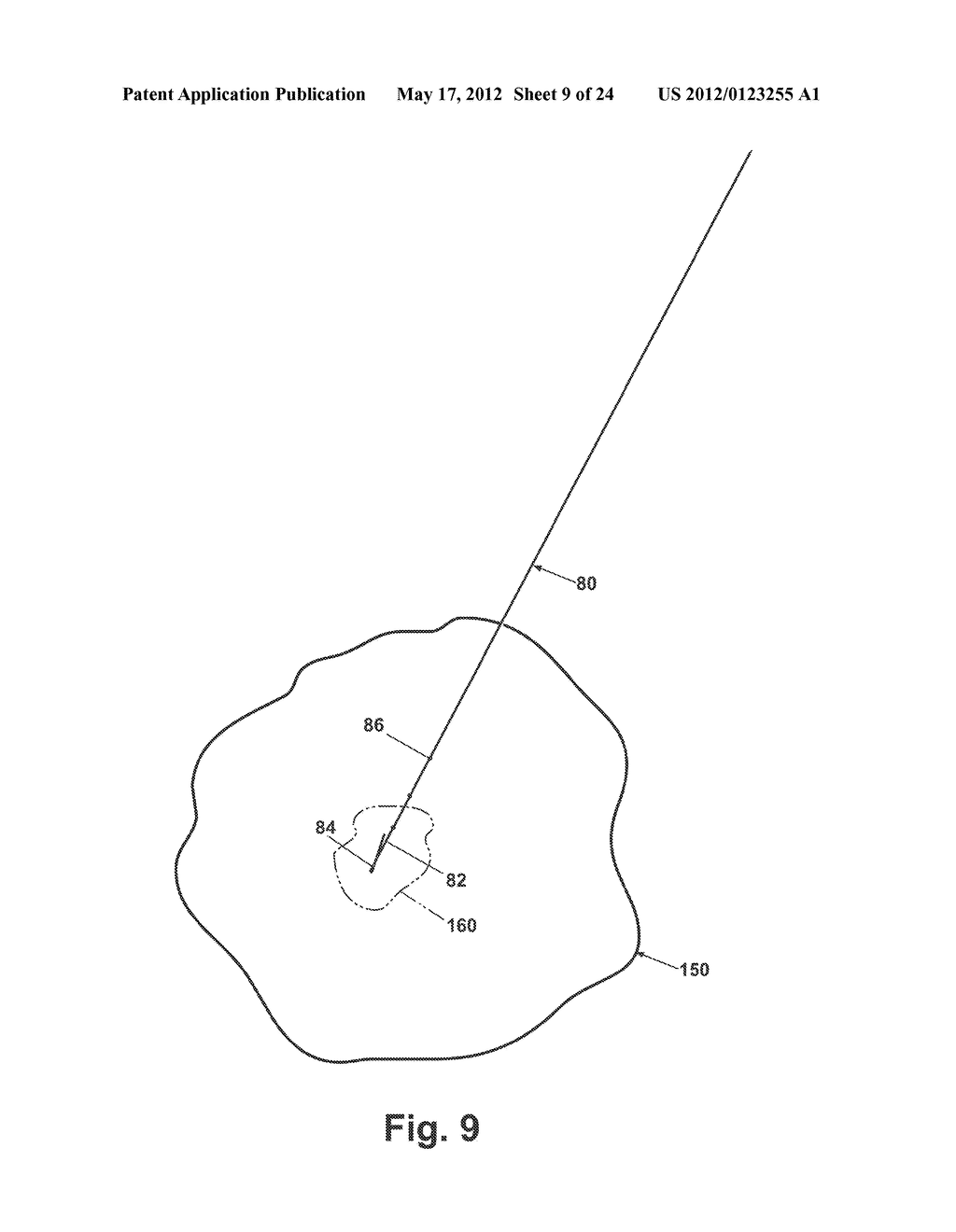 APPARATUS FOR IMPLANTING A PRELOADED LOCALIZATION WIRE - diagram, schematic, and image 10