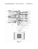 Spinal motion measurement device diagram and image