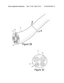 Minimally Invasive Access for Renal Nerve Ablation diagram and image