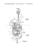 Minimally Invasive Access for Renal Nerve Ablation diagram and image