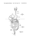 Minimally Invasive Access for Renal Nerve Ablation diagram and image