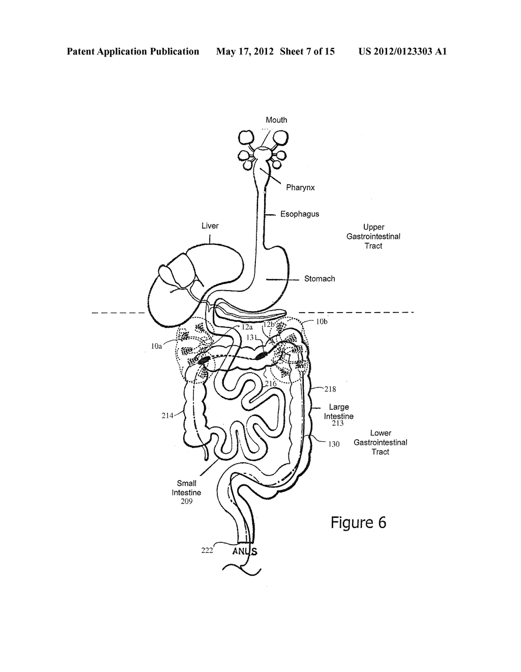 Minimally Invasive Access for Renal Nerve Ablation - diagram, schematic, and image 08