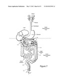 Minimally Invasive Access for Renal Nerve Ablation diagram and image