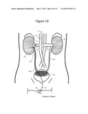 Minimally Invasive Access for Renal Nerve Ablation diagram and image