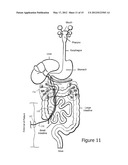 Minimally Invasive Access for Renal Nerve Ablation diagram and image