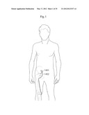 IMPLANTABLE LUBRICATION DEVICE AND METHOD OF TREATING A HUMAN OR MAMMAL     PATIENT BY MEANS OF THE DEVICE diagram and image