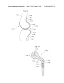 IMPLANTABLE LUBRICATION DEVICE AND METHOD OF TREATING A HUMAN OR MAMMAL     PATIENT BY MEANS OF THE DEVICE diagram and image