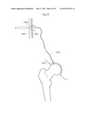 IMPLANTABLE LUBRICATION DEVICE AND METHOD OF TREATING A HUMAN OR MAMMAL     PATIENT BY MEANS OF THE DEVICE diagram and image