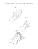 IMPLANTABLE LUBRICATION DEVICE AND METHOD OF TREATING A HUMAN OR MAMMAL     PATIENT BY MEANS OF THE DEVICE diagram and image