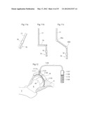 IMPLANTABLE LUBRICATION DEVICE AND METHOD OF TREATING A HUMAN OR MAMMAL     PATIENT BY MEANS OF THE DEVICE diagram and image