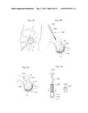 IMPLANTABLE LUBRICATION DEVICE AND METHOD OF TREATING A HUMAN OR MAMMAL     PATIENT BY MEANS OF THE DEVICE diagram and image