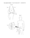 IMPLANTABLE LUBRICATION DEVICE AND METHOD OF TREATING A HUMAN OR MAMMAL     PATIENT BY MEANS OF THE DEVICE diagram and image