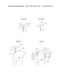 IMPLANTABLE LUBRICATION DEVICE AND METHOD OF TREATING A HUMAN OR MAMMAL     PATIENT BY MEANS OF THE DEVICE diagram and image