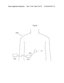 IMPLANTABLE LUBRICATION DEVICE AND METHOD OF TREATING A HUMAN OR MAMMAL     PATIENT BY MEANS OF THE DEVICE diagram and image