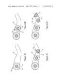 ERODIBLE EMBOLIZATION MATERIAL diagram and image