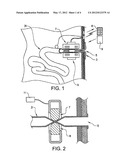 ABSORBING SEALING DEVICE FOR AN INTESTINAL STOMA diagram and image