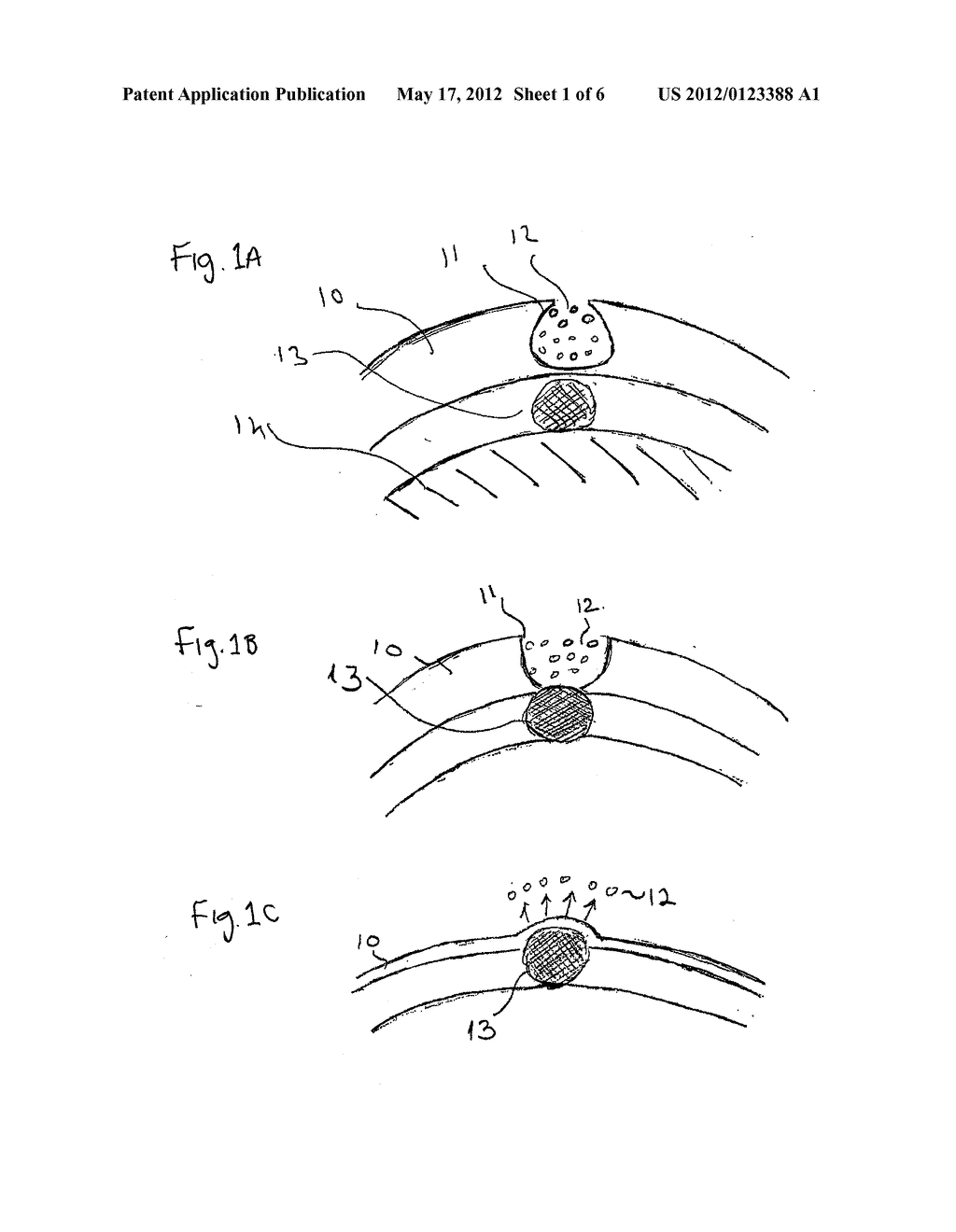 METHOD AND APPARATUS FOR TRANSPORT OF SUBSTANCES INTO BODY TISSUE - diagram, schematic, and image 02