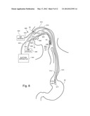 Medical Apparatus With Hypopharyngeal Suctioning Capability diagram and image