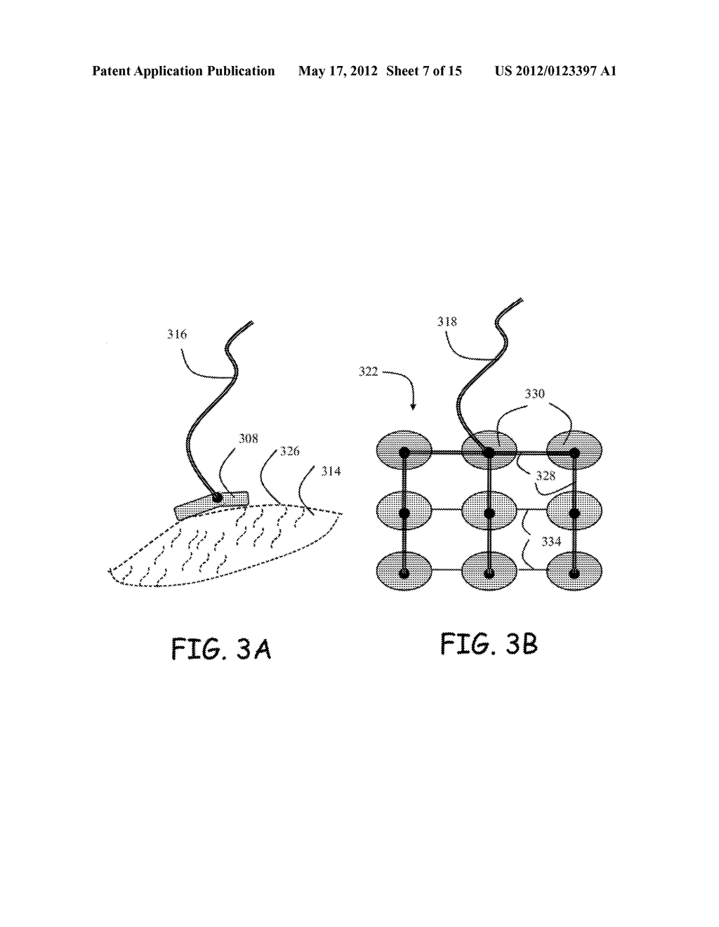 METHOD AND APPARATUS FOR LIPOSUCTION - diagram, schematic, and image 08