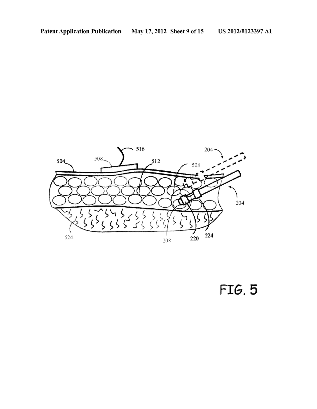 METHOD AND APPARATUS FOR LIPOSUCTION - diagram, schematic, and image 10