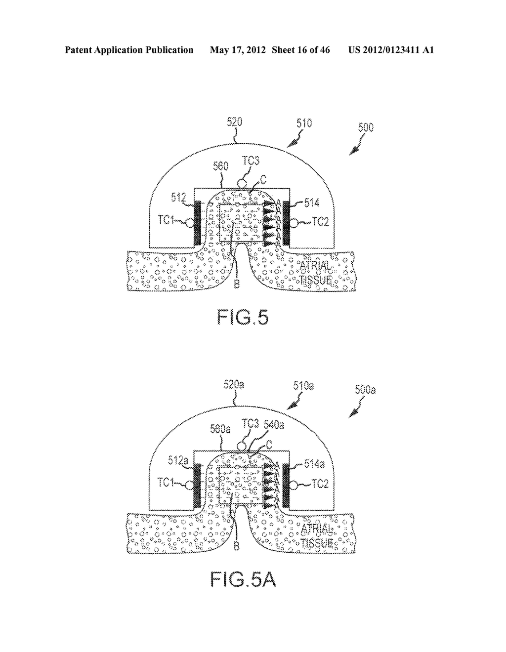 STABILIZED ABLATION SYSTEMS AND METHODS - diagram, schematic, and image 17