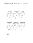 Devices, Methods and Systems for Remedying or Preventing Fractures diagram and image