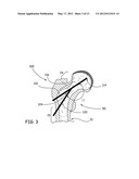 Devices, Methods and Systems for Remedying or Preventing Fractures diagram and image