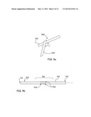 Devices, Methods and Systems for Remedying or Preventing Fractures diagram and image