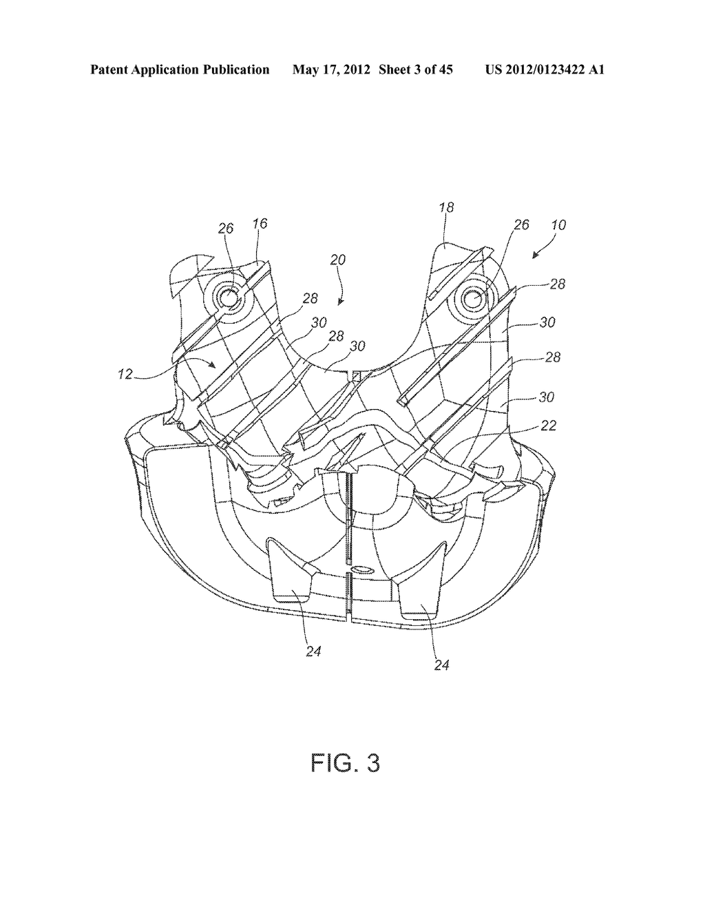 Patient-Matched Instruments - diagram, schematic, and image 04