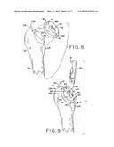 PATIENT-SPECIFIC INSTRUMENTS FOR TOTAL HIP ARTHROPLASTY diagram and image