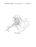 PATIENT-SPECIFIC INSTRUMENTS FOR TOTAL HIP ARTHROPLASTY diagram and image