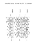 AXIALLY VARIABLE RADIAL PRESSURE CAGES FOR CLOT CAPTURE diagram and image