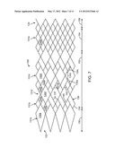 AXIALLY VARIABLE RADIAL PRESSURE CAGES FOR CLOT CAPTURE diagram and image