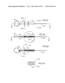 SURGICAL COILS AND METHODS OF DEPLOYING diagram and image