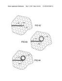 SURGICAL COILS AND METHODS OF DEPLOYING diagram and image