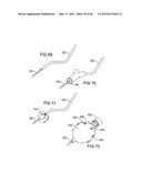 SURGICAL COILS AND METHODS OF DEPLOYING diagram and image