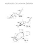 SURGICAL COILS AND METHODS OF DEPLOYING diagram and image