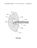 SURGICAL COILS AND METHODS OF DEPLOYING diagram and image