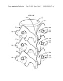 LOW PROFILE SPINAL PROSTHESIS INCORPORATING A BONE ANCHOR HAVING A     DEFLECTABLE POST AND A COMPOUND SPINAL ROD diagram and image