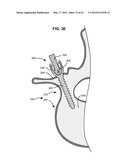 LOW PROFILE SPINAL PROSTHESIS INCORPORATING A BONE ANCHOR HAVING A     DEFLECTABLE POST AND A COMPOUND SPINAL ROD diagram and image