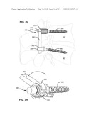 LOW PROFILE SPINAL PROSTHESIS INCORPORATING A BONE ANCHOR HAVING A     DEFLECTABLE POST AND A COMPOUND SPINAL ROD diagram and image